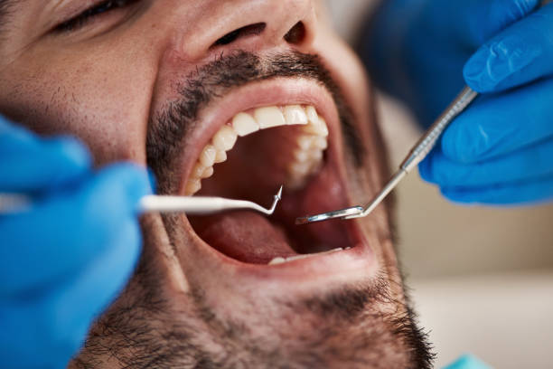 Best Emergency Dental Care for Broken or Chipped Teeth in Clinton, MS