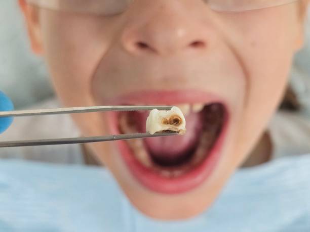 Best Emergency Tooth Extraction in Clinton, MS